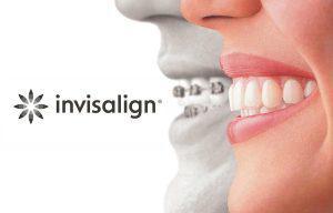 Invisalign® Orthodontist in Sacramento, CA